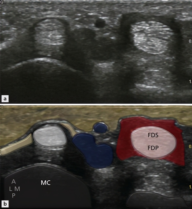 女性更年期大拇指腱鞘炎怎么治,更年期女性手指腱鞘炎的中药配方
