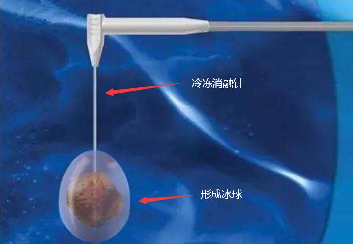 什么是冷冻消融术,三甲医院为什么没有冷冻消融技术