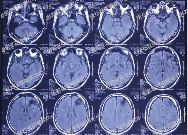 颞叶海绵状血管瘤癫痫微创手术,唐都医院脑肿瘤微创手术
