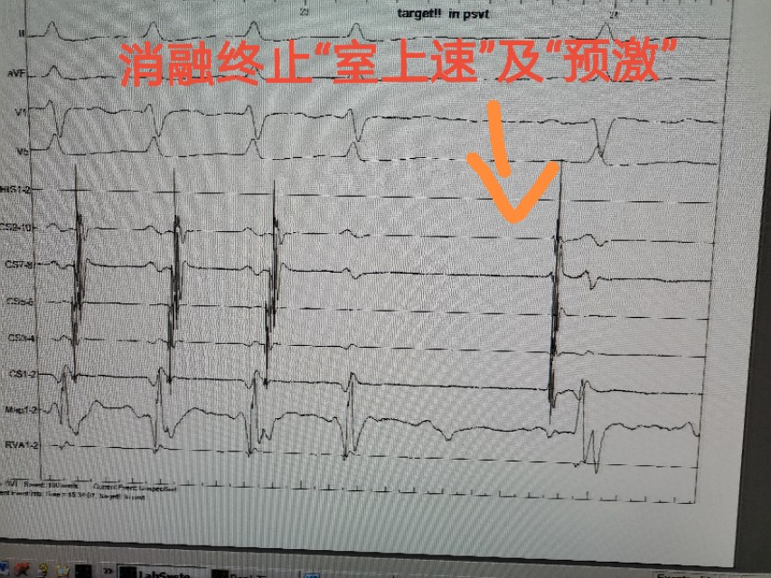 孕妇心动过速外加有点心肌缺血,怀孕心电图窦性心动过速心慌胸闷