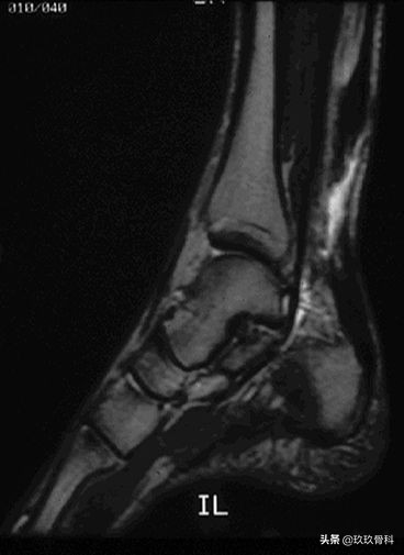 跟腱断裂的确诊方法,超详细跟腱断裂的诊断与治疗