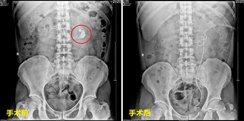 祸不单行因祸得福案例,祸不单行因祸得福的视频