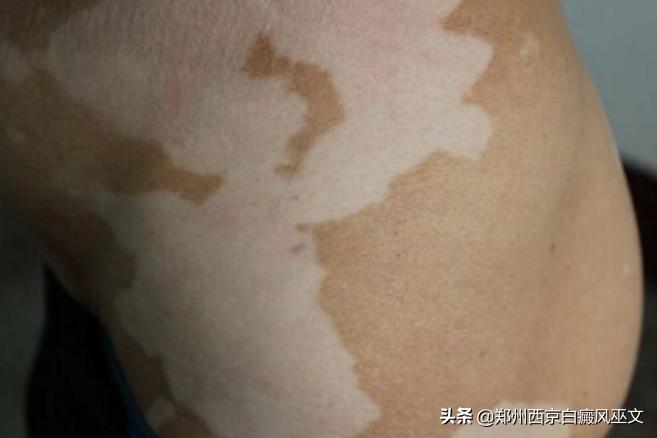 父子都得白癜风,父子都有白癜风