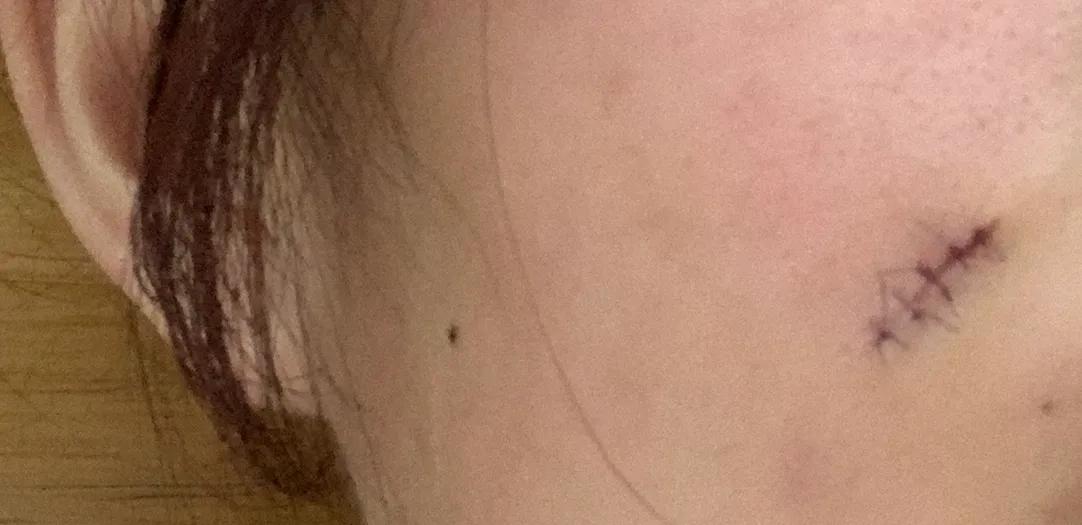 耳朵切痣恢复图片,切痣手术后恢复过程图