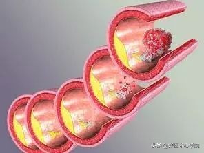 最常见的血栓类型是,最致命血栓视频