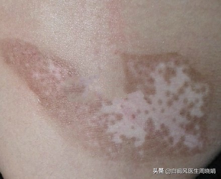「不慌~」脸上长了这种白斑别慌！医生让你这么做