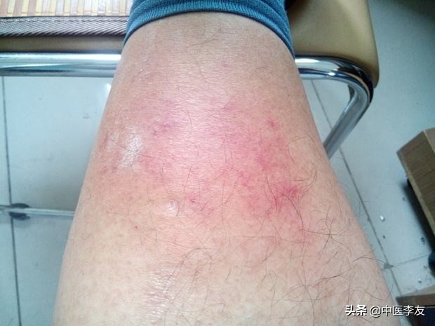 针灸学针刺的操作步骤和注意事项,学习针灸如何快速记住穴位