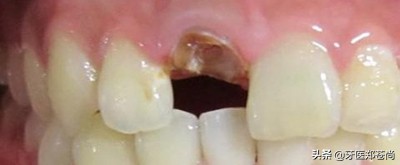 蛀牙只剩根了好拔吗,蛀牙只剩牙根怎么办还能补牙么