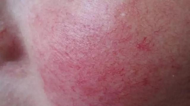 颜值杀手薇尔莉特,常见的影响颜值的皮肤病