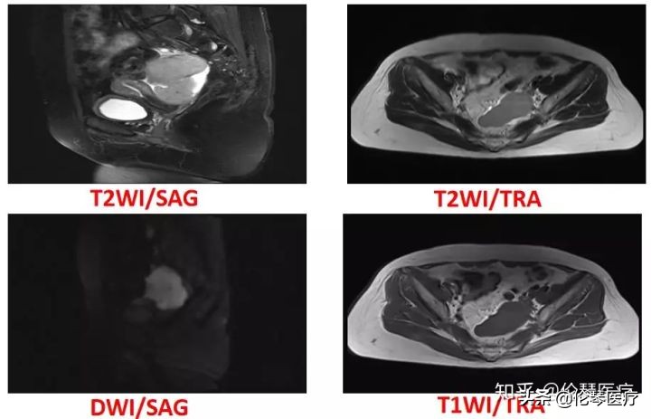 卵巢肿瘤核磁共振能看出来吗,超声测出来肿瘤