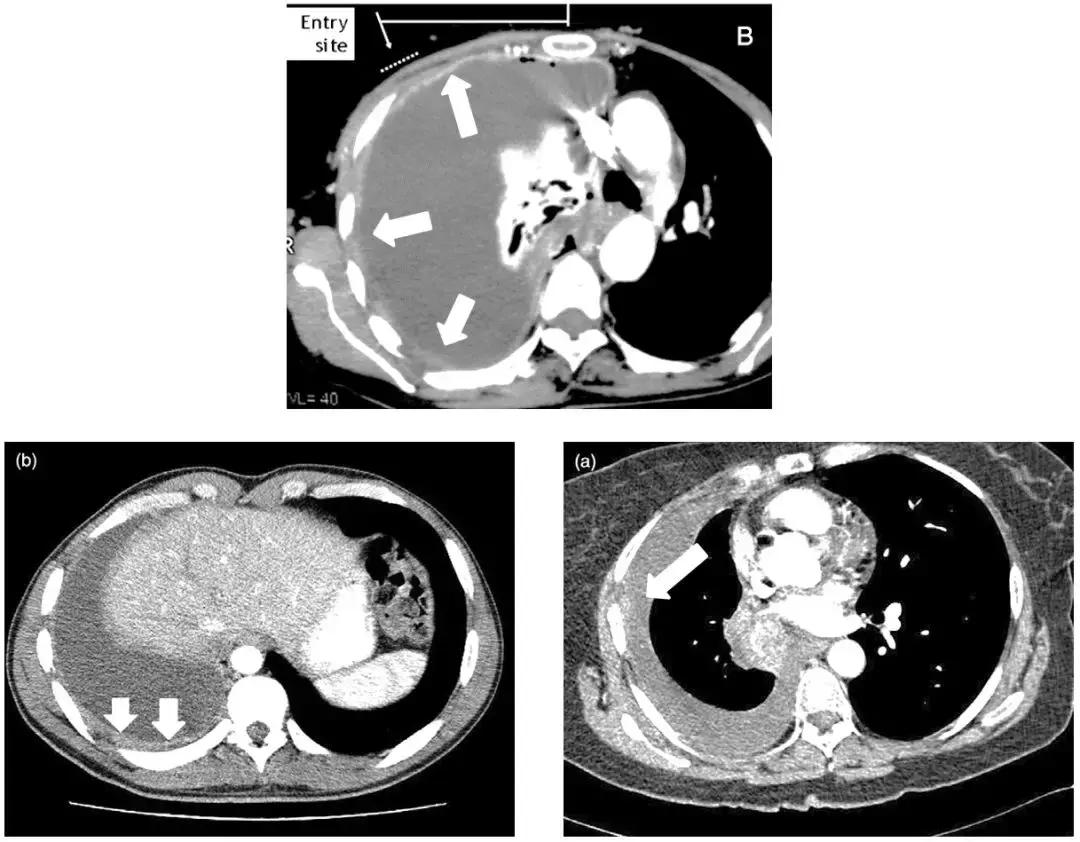 胸部超声引导下穿刺活检术流程,ct引导下肺穿刺活检优缺点