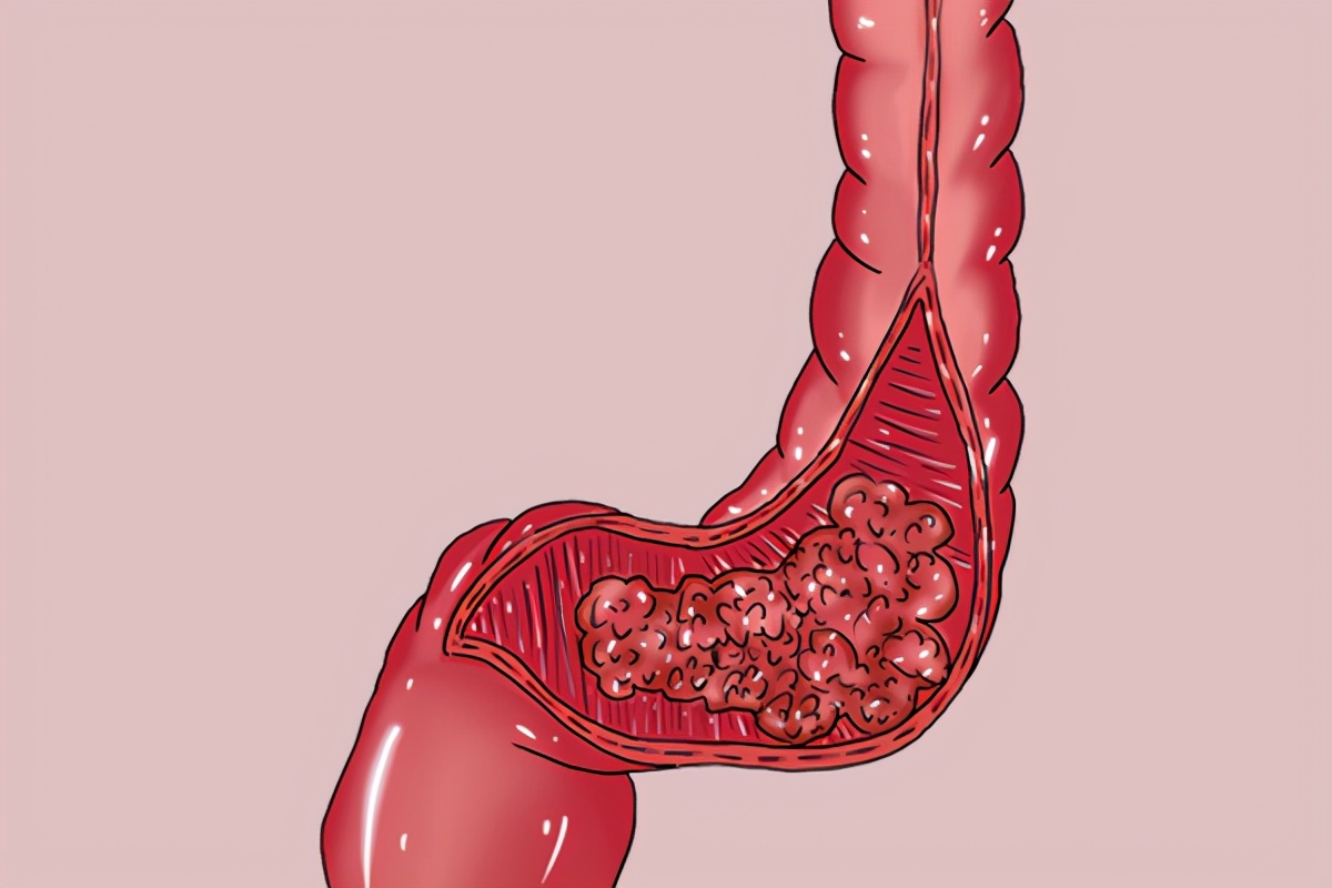 肠道堵怎么算痊愈,肠道改善方法
