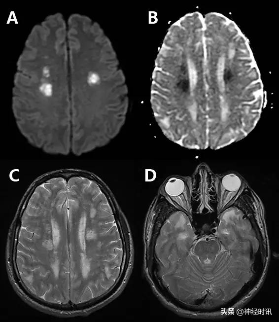 脑卒中病历诊断书图片,脑卒中影像判断技巧图解电子版