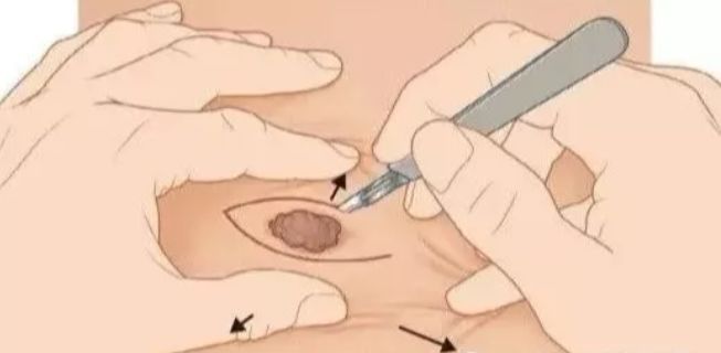 中医院点痣方法,中医治疗点痣