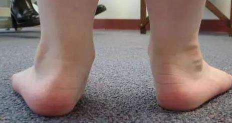 医生谈矫正宝宝内八字的方法,宝宝走路内八字症状