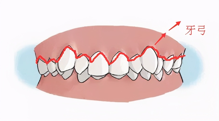 成年人牙齿矫正戴上牙套嘴巴变凸,扩弓会使脸型变大吗