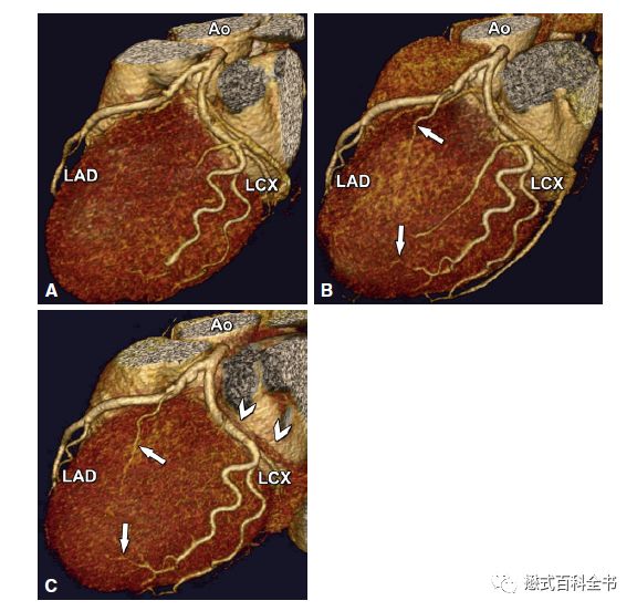 ct排数和层数区别,ct排与层的区别