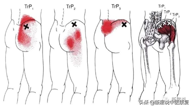腰痛、膝痛、髋关节失稳？都是臀中肌无力惹的祸