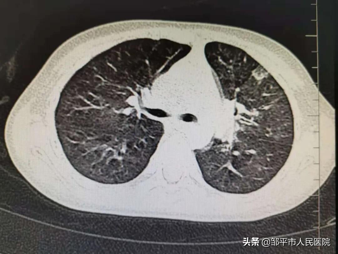 重症肺炎最佳治疗方法,满月宝宝重症肺炎如何治疗