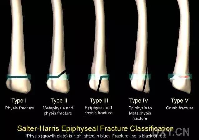 几种严重骨折医学名称,常见的骨折有哪些名称