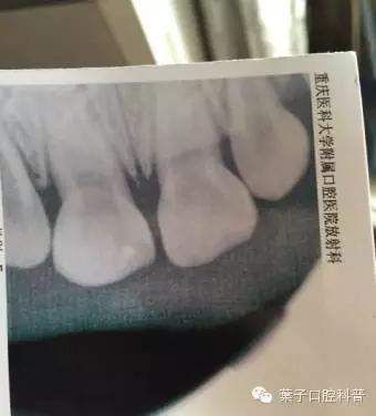 儿童牙齿摔断残根是否需要拔除,小孩牙齿摔断了牙根会跟着烂吗