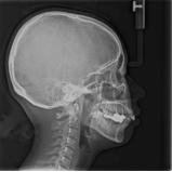 烤瓷冠连着做和单做有什么区别,烤瓷牙矫正成功案例