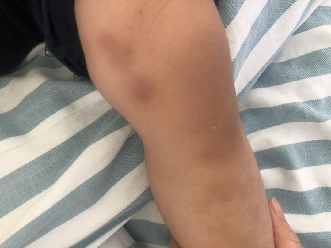 深圳2兄妹身上频现“离奇淤青”，医生：可能是吃出来的！咋回事？