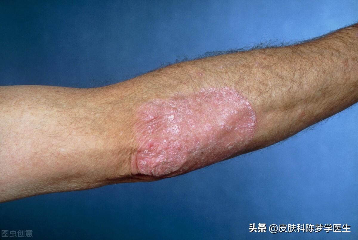 皮肤上的红斑可能是牛皮癣吗,红斑和脱屑的牛皮癣