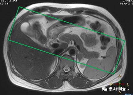 开展mrcp技术,mrcp检查操作流程