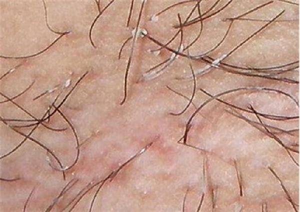 毛发稀少毛躁,毛发稀少一定是雄性激素不足吗