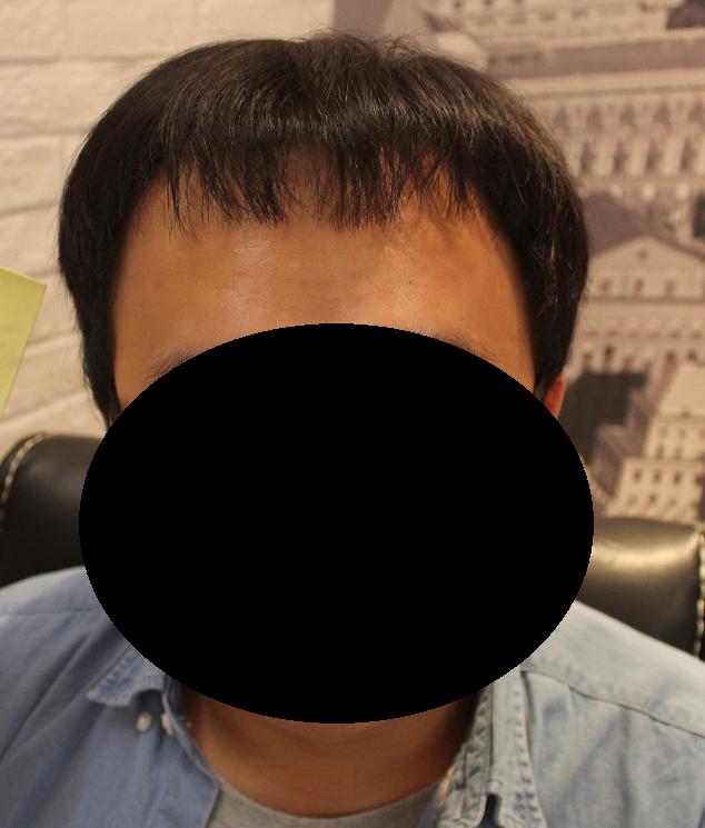 植发能和正常生长的头发一样长吗,植发靠谱吗