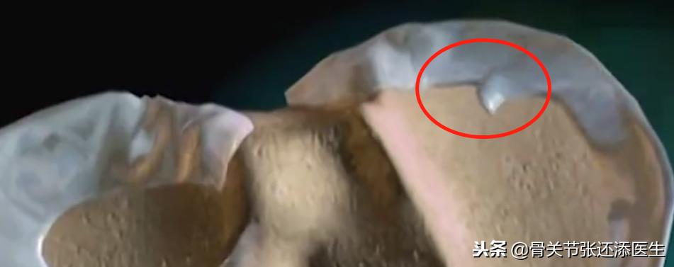韦德的半月板撕裂到什么程度,韦德半月板损伤