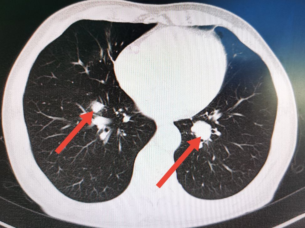 直肠癌转移肺部ct报告单怎样提示,直肠癌转移到肝肺部还能活多久