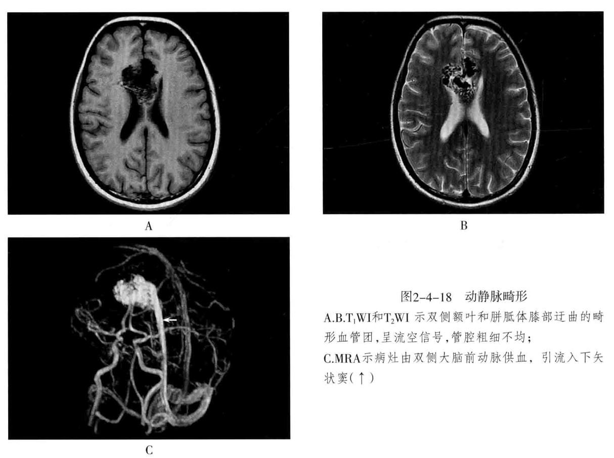 颅内血管周围间隙的影像鉴别,颅脑血管源性疾病影像诊断