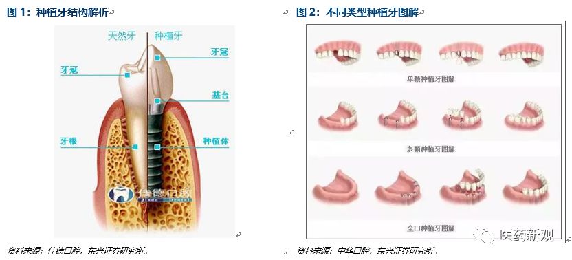 种植牙技术排行,种植牙材料行业怎么样