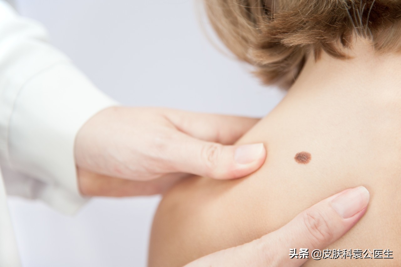 色素痣恶变的几种可能性,色素痣什么情况下排除恶变