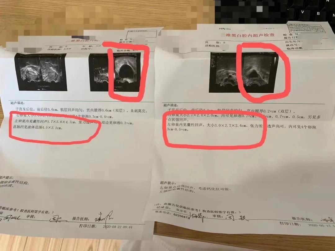 女性肚子有坠胀感是盆腔炎,姨妈不准却有痛经