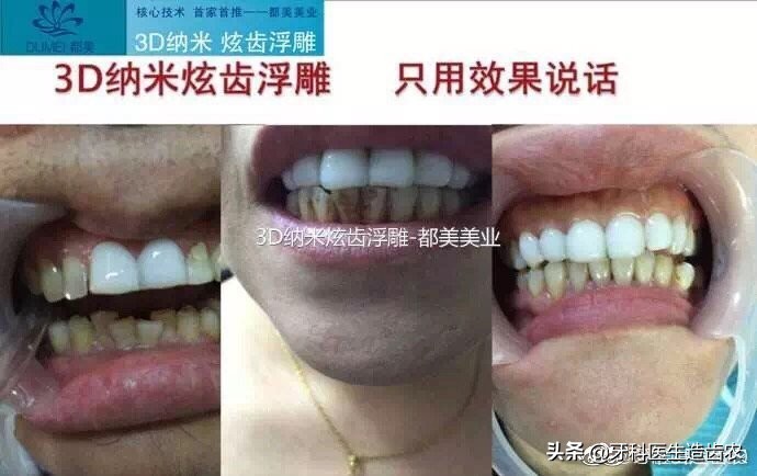 美牙师技术培训,美牙师学习