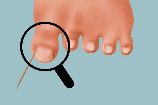 彻底治愈脚趾甲往肉里长的方法,脚趾甲侧面嵌甲自己怎么处理