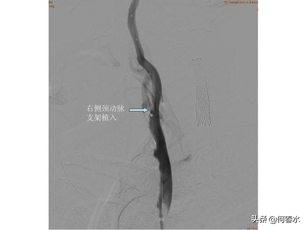 颈动脉狭窄介入治疗,颈动脉狭窄介入手术多少钱