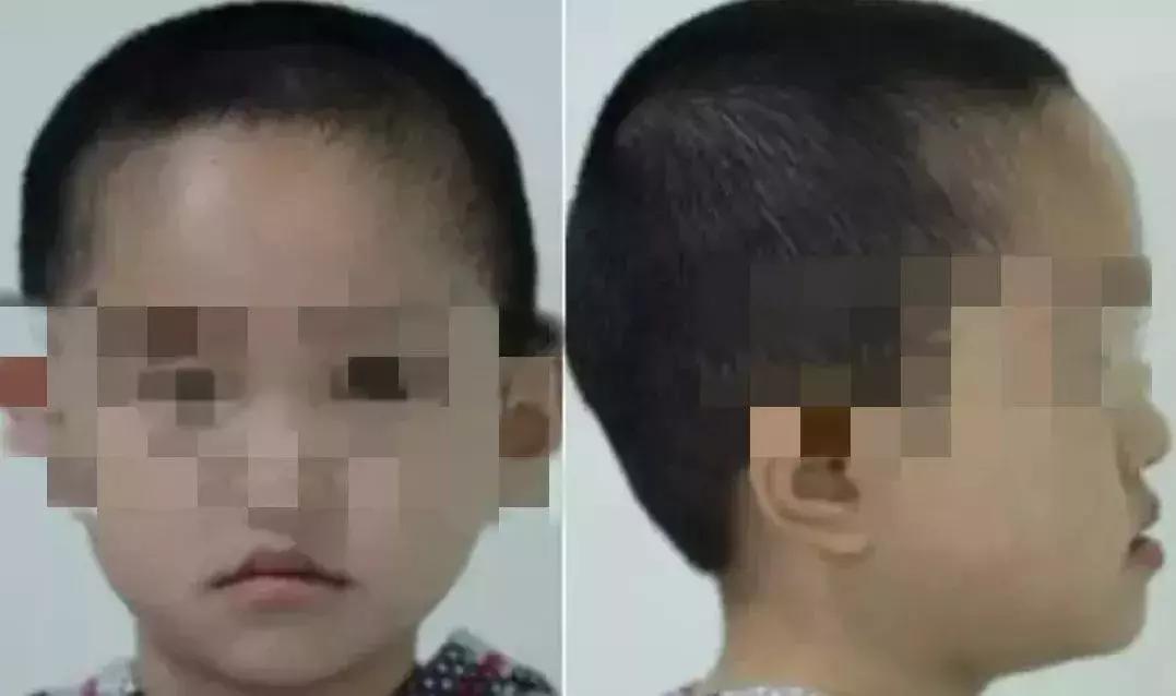 什么叫地包天怎么治疗,什么叫地包天能矫正吗