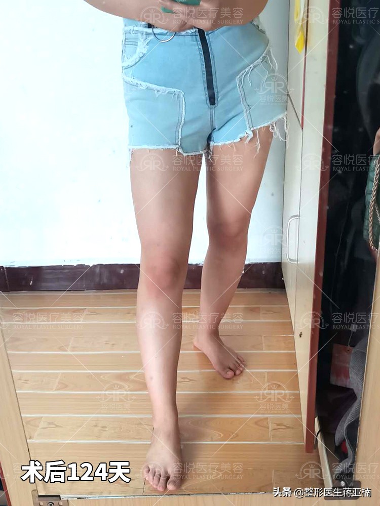 大腿吸脂后变胖,大腿吸脂拯救我的大粗腿