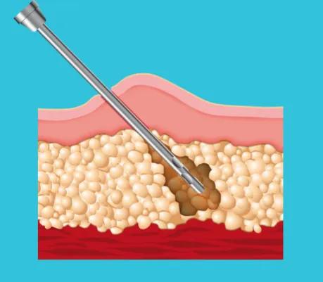 哪些人适合穿塑身衣,长期穿塑身衣对女性造成哪些危害