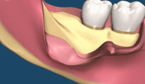 拔智齿是怎么算收费的,拔智齿是按智齿个数收费吗