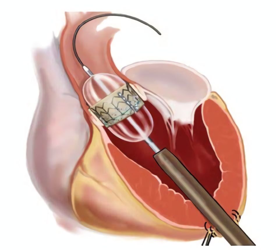 心瓣膜疾病病人的护理,瓣膜性心脏病内科治疗指南