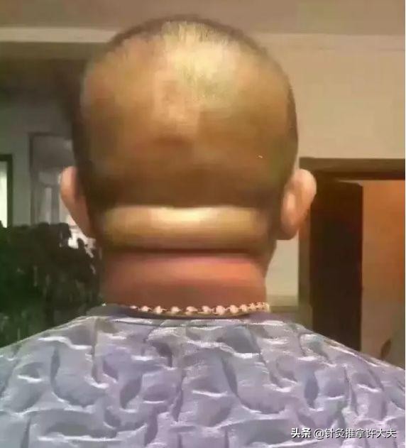 脖子摸着有点包是咋回事,脖子摸着硬怎么回事