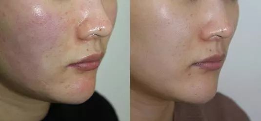 去黄提亮紧致茶面膜,韩国茶树面膜