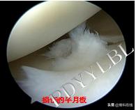 半月板修复视频教程,半月板术后修复