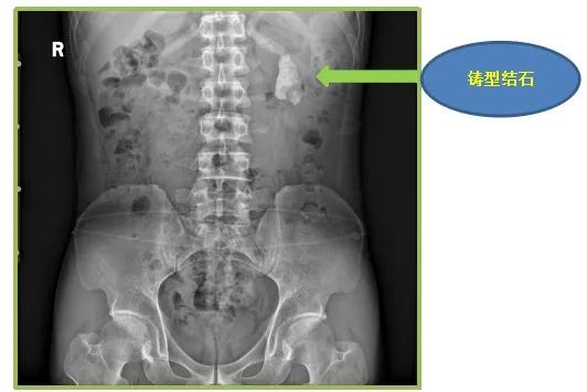 肾结石鸡蛋那么大能手术吗,鸡蛋大的肾结石要怎么处理