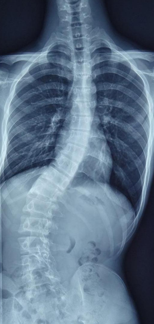 成年人脊柱歪,成年人脊椎弯了怎么办